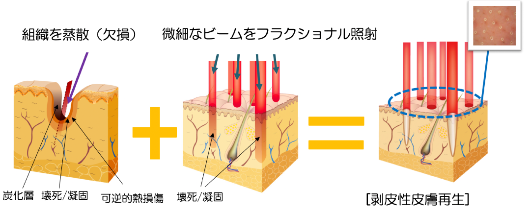 フラクショナルレーザーの作用