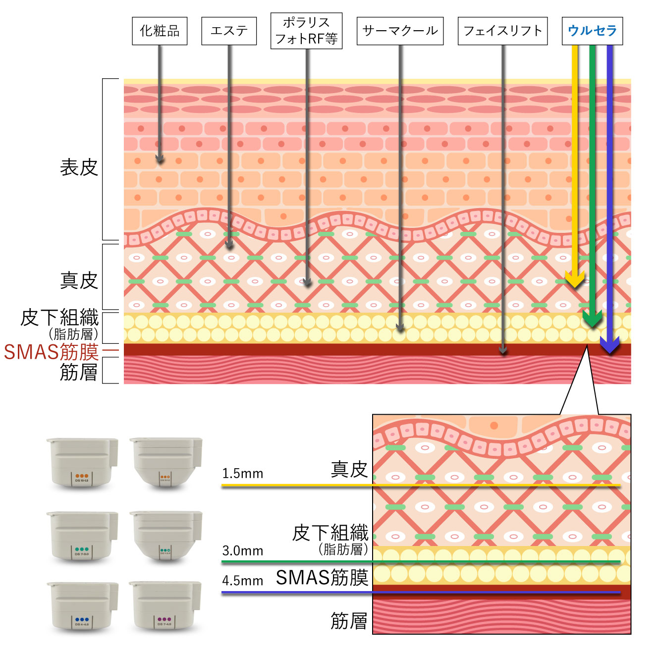 ウルセラ比較図