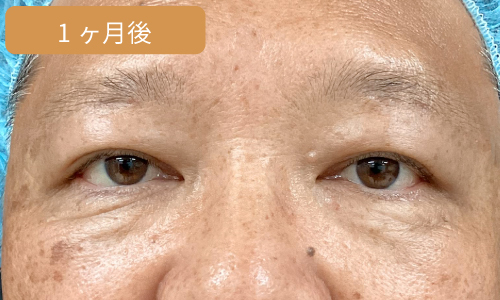 施術1ヶ月後