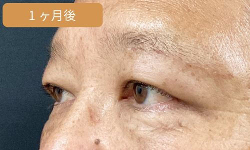 施術1ヶ月後