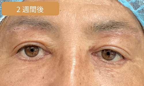 施術2週間後