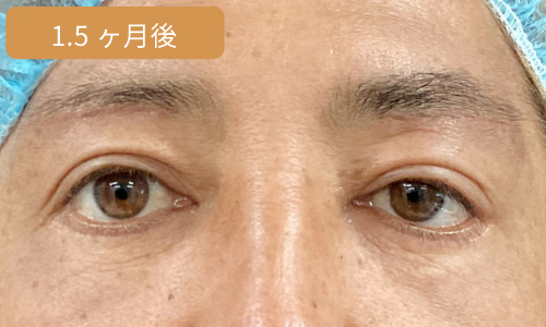 施術1ヶ月後