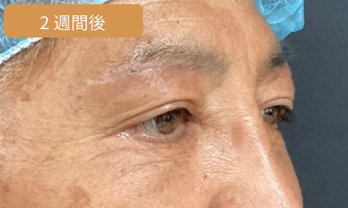 施術2週間後