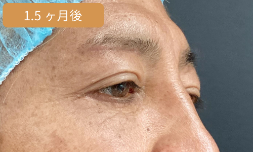 施術1ヶ月後