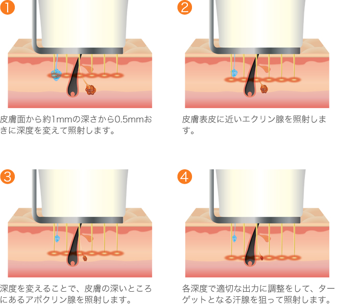 ビューホットRFカートリッジ