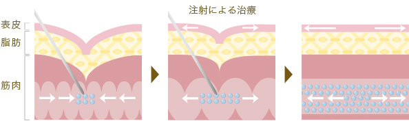 ボトックス注射について