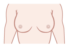 乳房縮小とは