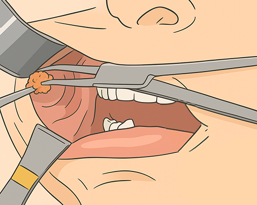 バッカルファットの施術