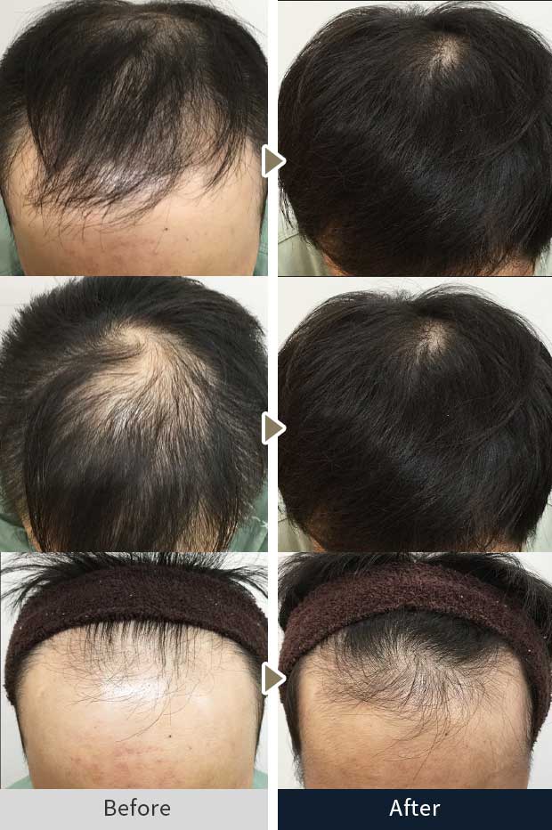 HARG＋療法症例写真