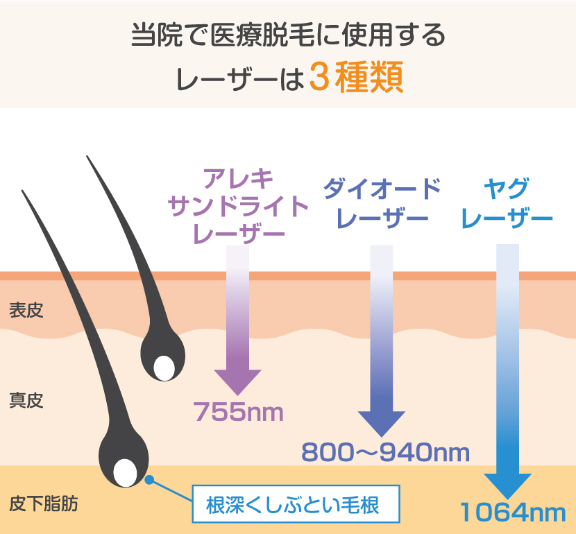 医療レーザー脱毛の種類