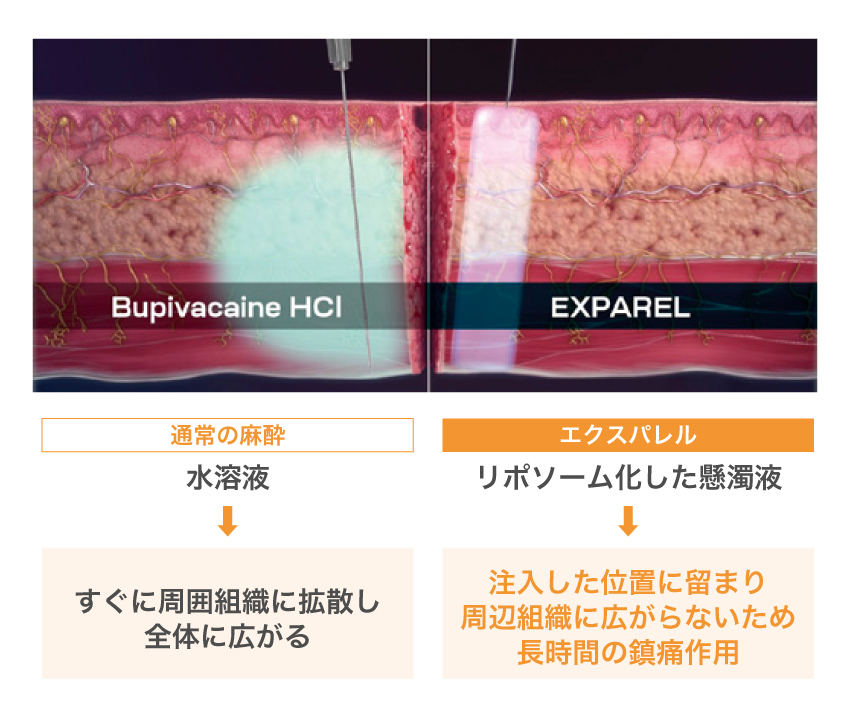 通常の麻酔とエクスパレルの違い