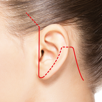 耳前部の直線的な切開