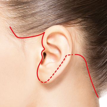 もみあげ〜耳前部〜耳垂を経由して耳の裏の生え際にそった切開