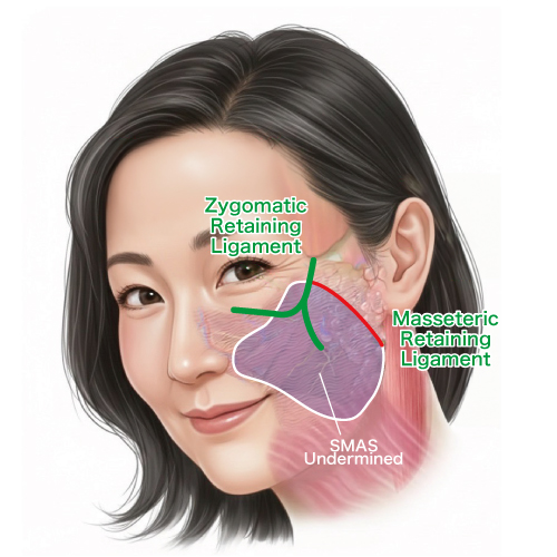 Deep Plane Facelift（ディーププレーンフェイスリフト）
