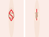 施術