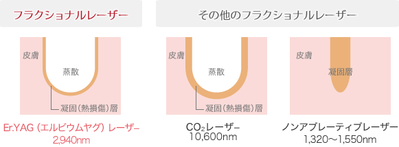 表面ヤケドを起こさせないので回復が早い