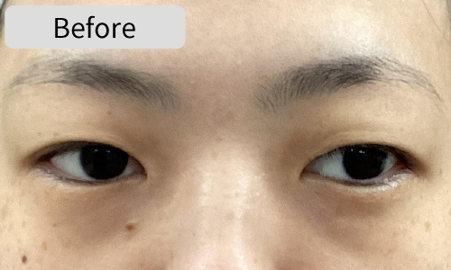 全切開法症例Before