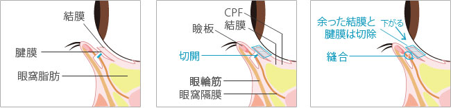 切開法について