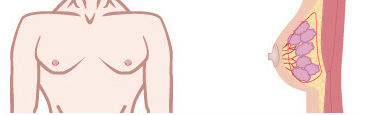 真性女性化乳房(乳腺が発達している場合)