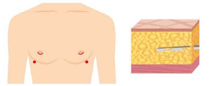 偽性女性化乳房（肥満による膨らみの場合）