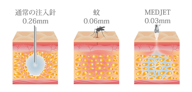 メドジェットが痛くない理由