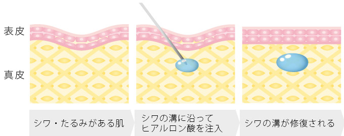 ヒアルロン酸注入法