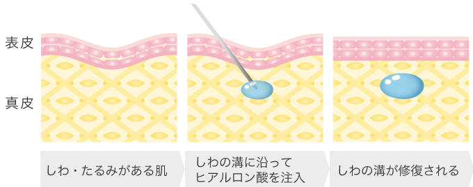 ヒアルロン酸注入法