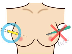 シリコンバックや脂肪注入に対して抵抗がある方