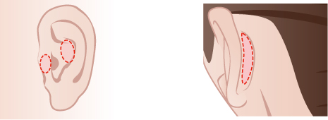耳介軟骨移植の方法