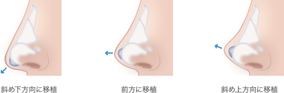 耳介軟骨移植のデザインについて