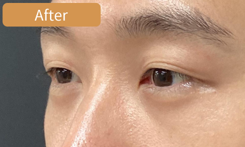 経結膜脱脂法症例After