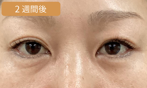 経結膜脱脂法症例After