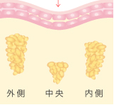 一般的な経結膜脱脂法