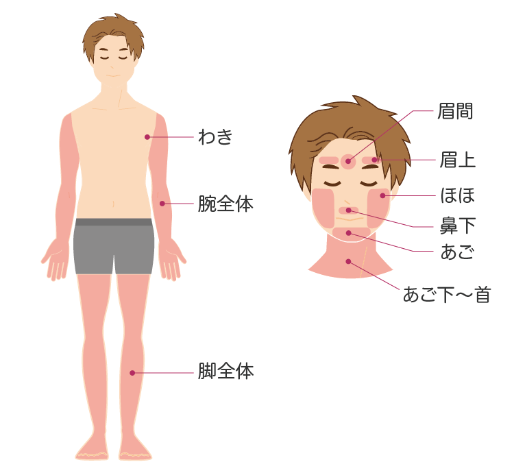 子供脱毛 男の子の範囲