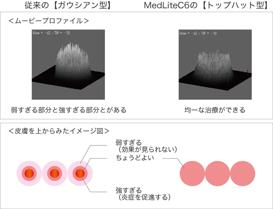 レーザー照射の図