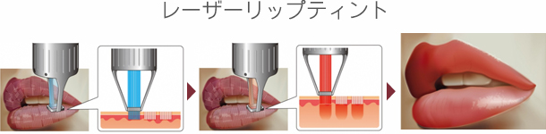 レーザーリップティントとは