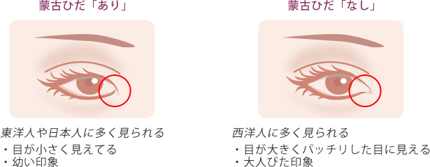 蒙古ひだあり 蒙古ひだなし