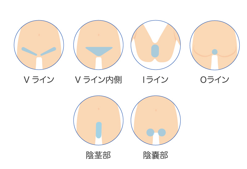 男性VIO脱毛の範囲