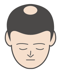 O字ハゲ