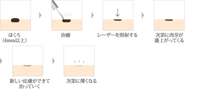 電気分解法 + レーザー治療