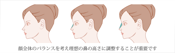 顔全体のバランスを考え理想の鼻の高さに調整することが重要です