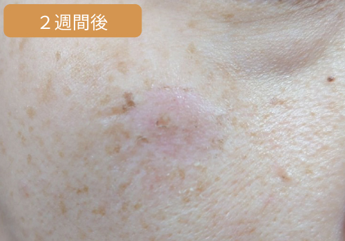施術2週間後