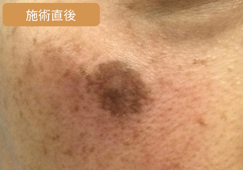 施術直後