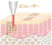 PICOレーザー照射