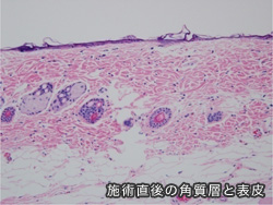 施術直後の角質層と表皮