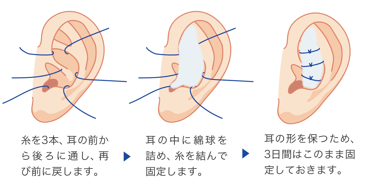 固定の方法