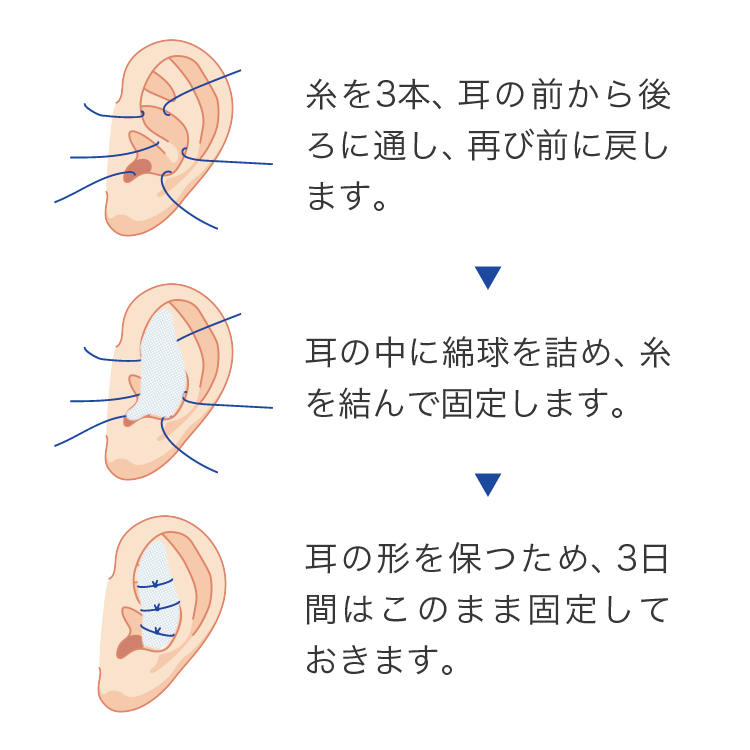 固定の方法