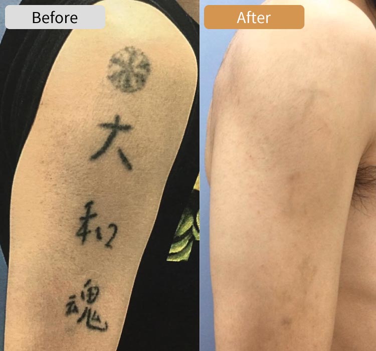 ピコレーザータトゥー除去症例