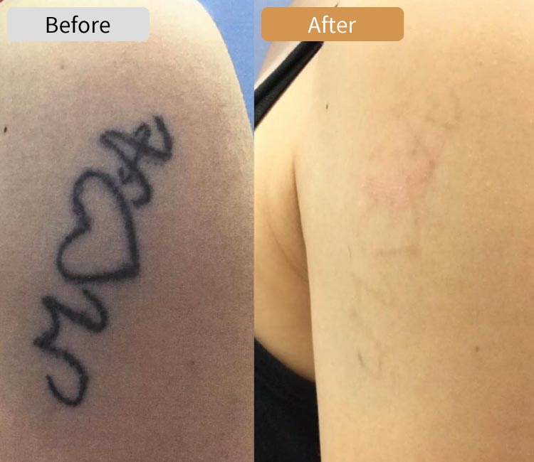 ピコレーザータトゥー除去症例