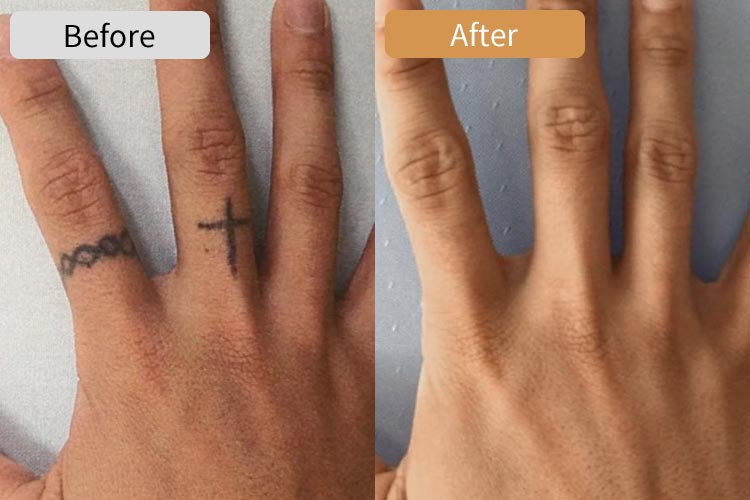 ピコレーザータトゥー除去症例